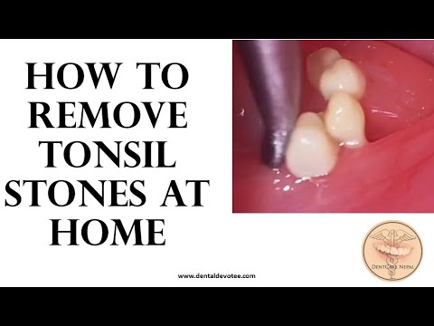 How to remove tonsil stones at home - Tonsil stone removal